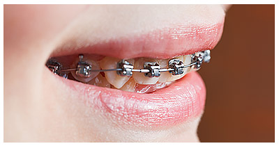 girls mouth with damon braces