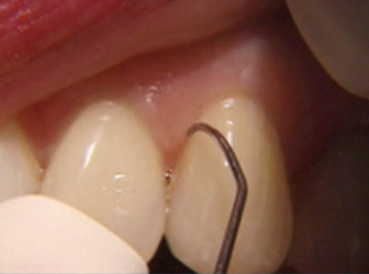removing plaque below the gum-line