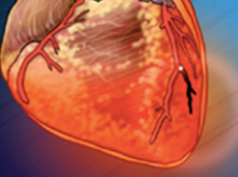 inflamed heart tissues