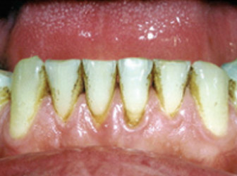 tobacco stained teeth