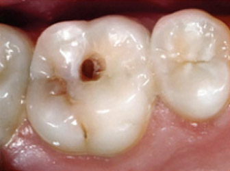 a visible cavity