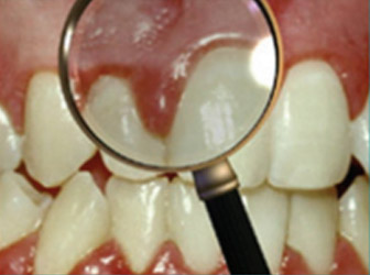 Signs of periodontal disease